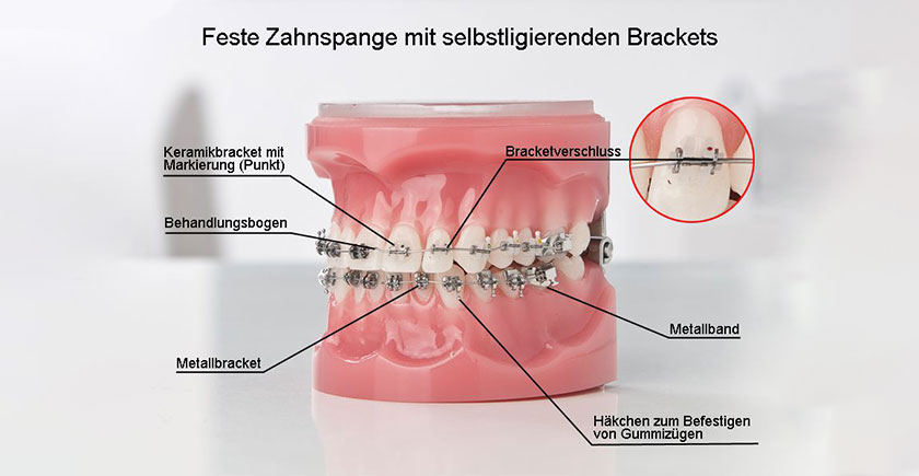 Zahnspange in Unna / HoWi – auch mit Keramik- und Minibrackets